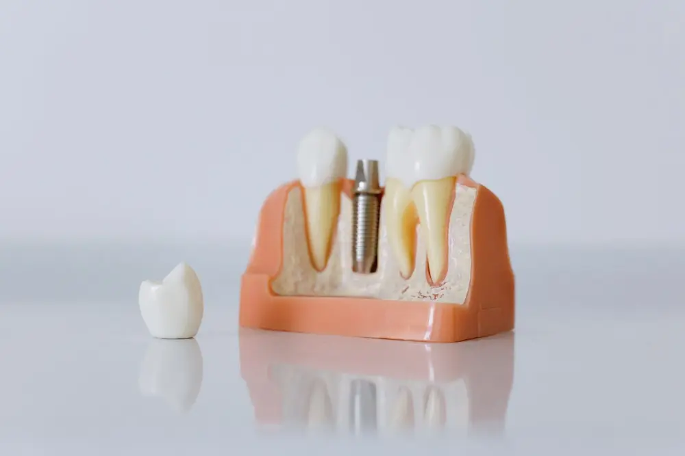 Model didactic: implant dentar între doi dinți naturali