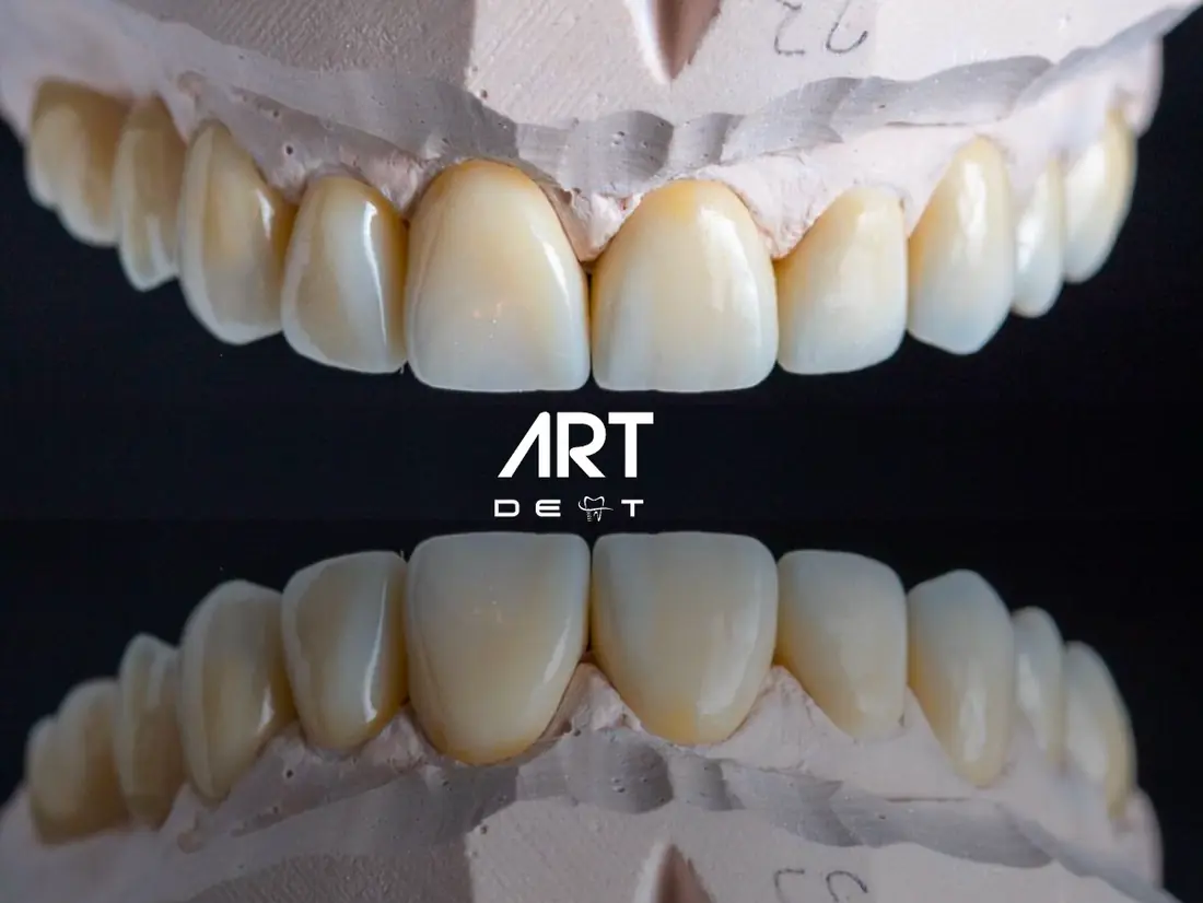 Coroane din zirconiu realizate în laboratorul Art Dent