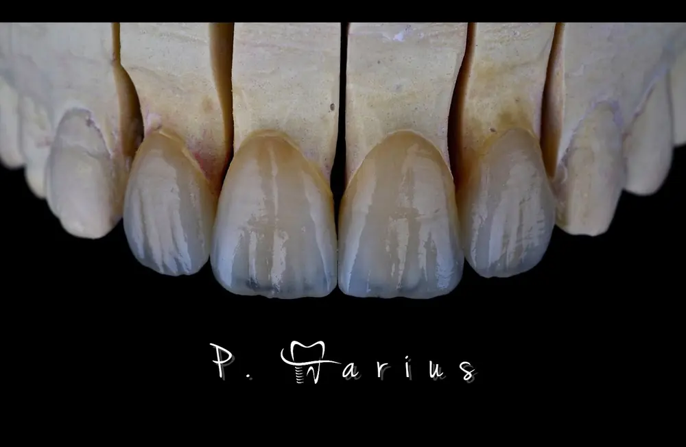 Lucrări ceramice frontale pe model
