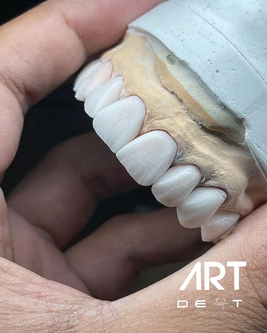 Fațete ceramice ținute în mână, pe model